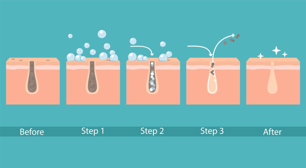 Cleansing stages on clogged face