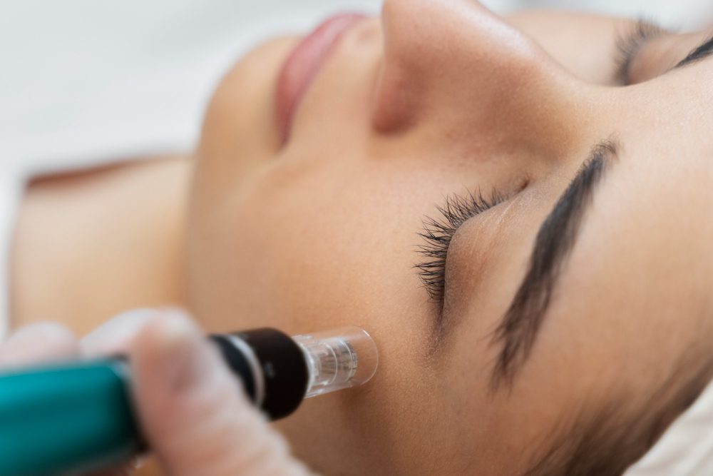 dermapen microneedling